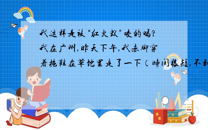 我这样是被“红火蚁”咬的吗?我在广州,昨天下午,我赤脚穿着拖鞋在草地里走了一下（时间很短,不到2分钟）,两只脚不知道被什么虫子咬了好几个包,很痒,有的在脚背上,有的在脚趾上,当时以