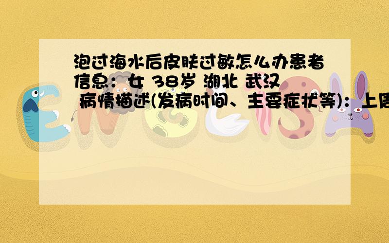 泡过海水后皮肤过敏怎么办患者信息：女 38岁 湖北 武汉 病情描述(发病时间、主要症状等)：上周全家去海南旅游,每天都去海边游泳,回武汉后膝盖以下特别痒,忍不住抓绕后出现很多小红点.